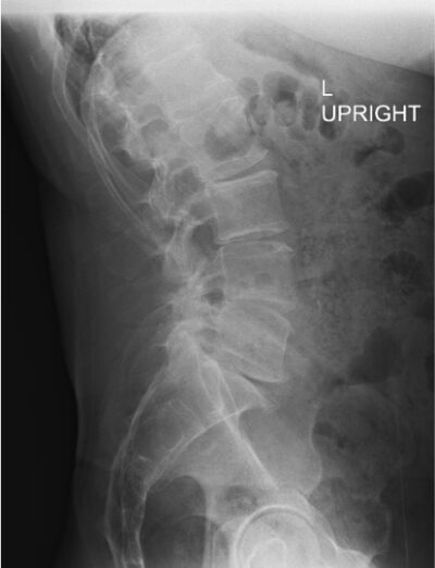 62 yo male with LBP and “Leg Drags” – Study Spine A to Z