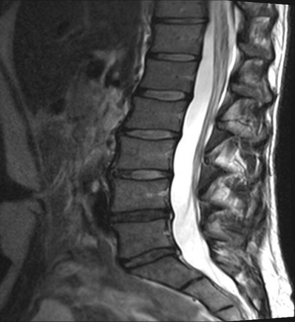 LBP for 1 Year. Was seen 3 years ago with lower LBP – Study Spine A to Z