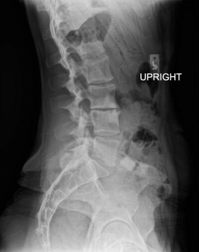 LBP for 1 Year. Was seen 3 years ago with lower LBP – Study Spine A to Z