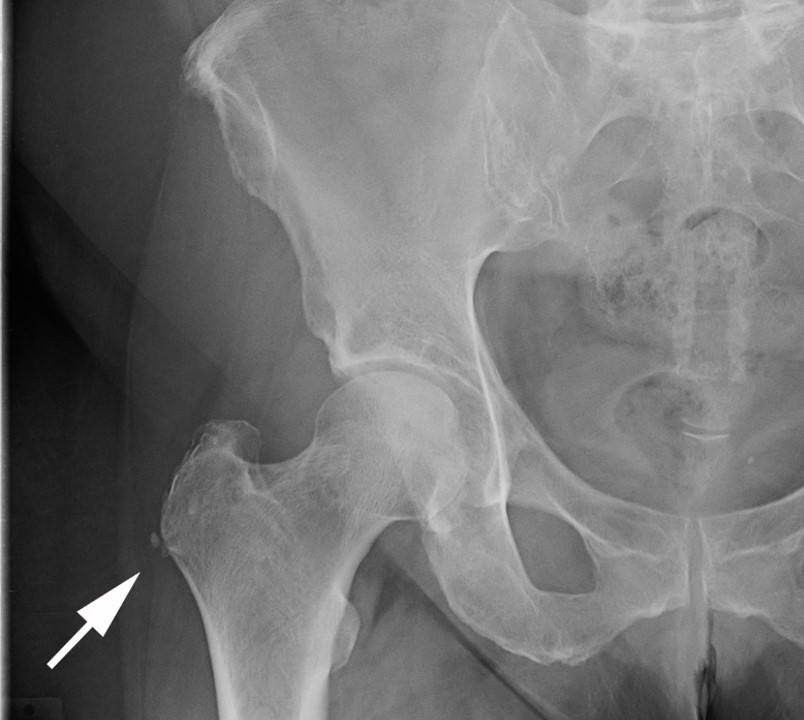 Hip Bursitis X Ray