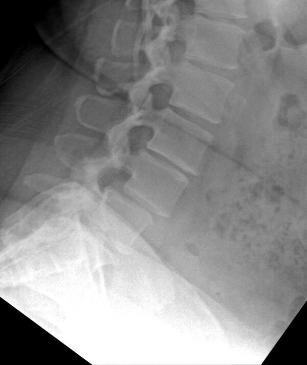 Neurogenic Claudication Symptoms – Study Spine A to Z