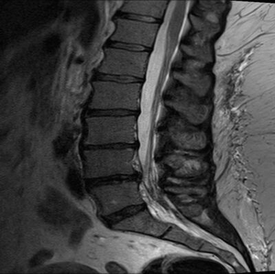 Neurogenic Claudication Symptoms – Study Spine A to Z