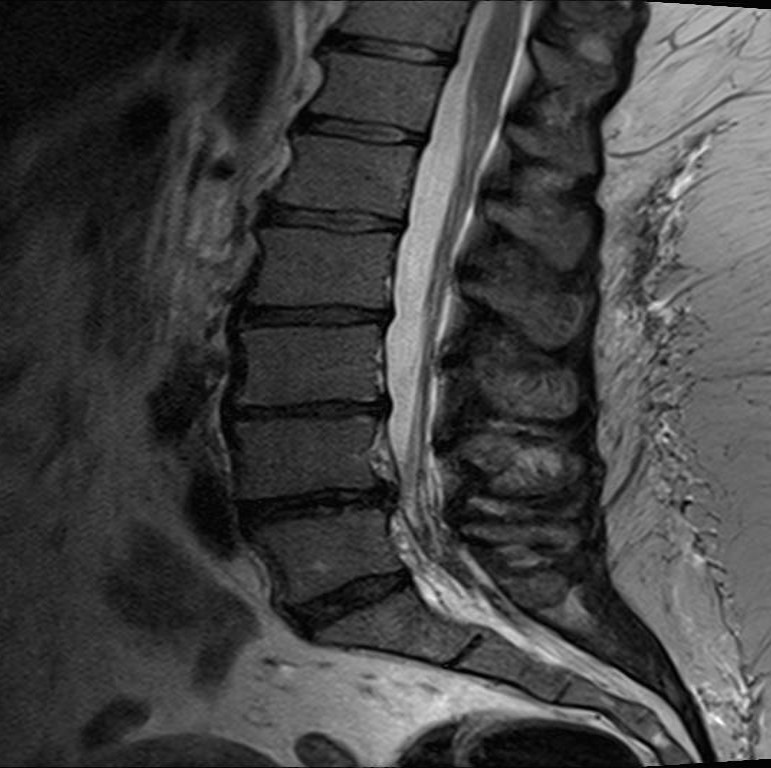 neurogenic-claudication-pathogenesis-and-clinical-findings-calgary-guide