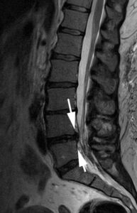 Neurogenic Claudication Symptoms – Study Spine A to Z