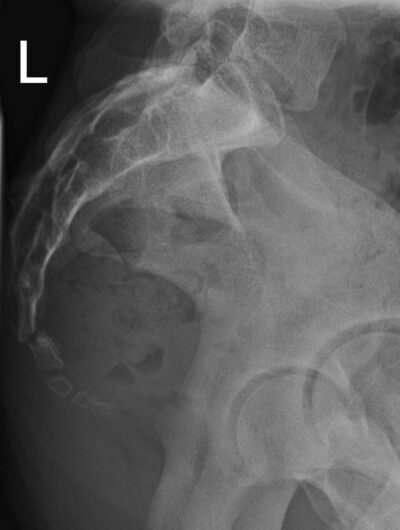 19 year old slipped on ice and fell directly on buttocks, C/O sacral ...